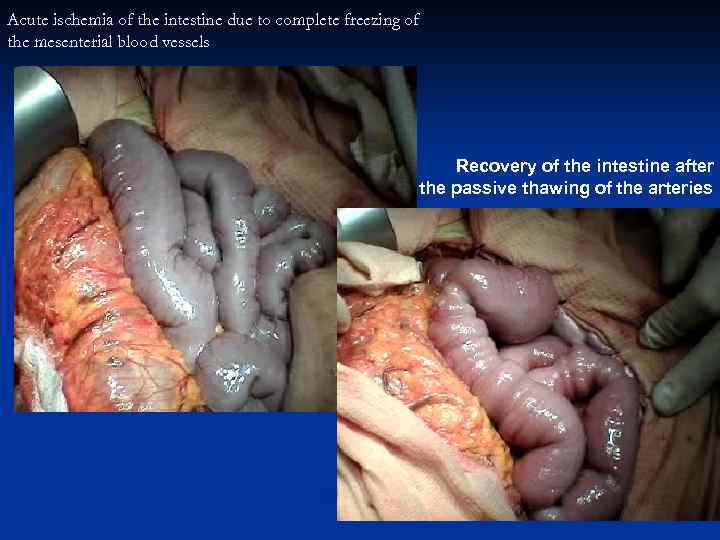 Acute ischemia of the intestine due to complete freezing of the mesenterial blood vessels