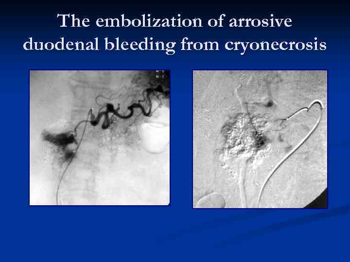 The embolization of arrosive duodenal bleeding from cryonecrosis 