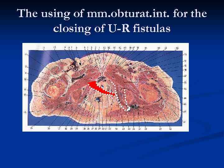 The using of mm. obturat. int. for the closing of U-R fistulas 