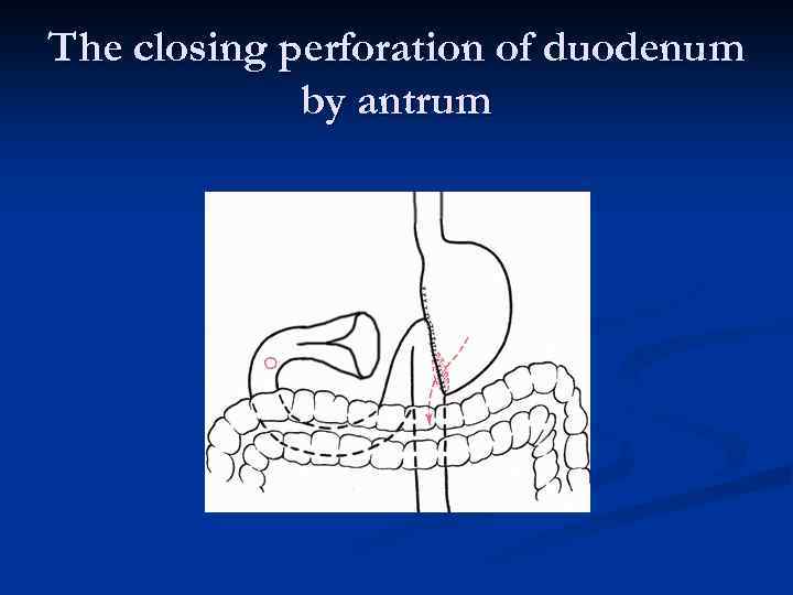 The closing perforation of duodenum by antrum 