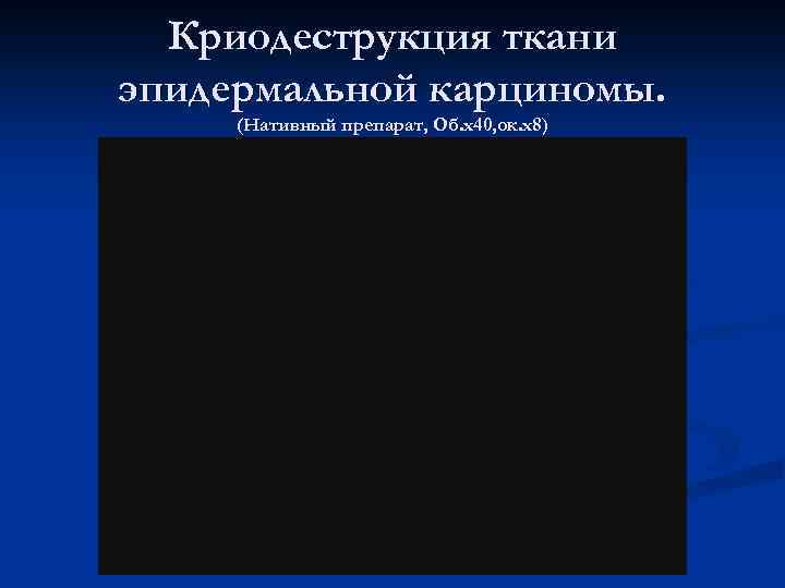 Криодеструкция ткани эпидермальной карциномы. (Нативный препарат, Об. х40, ок. х8) 
