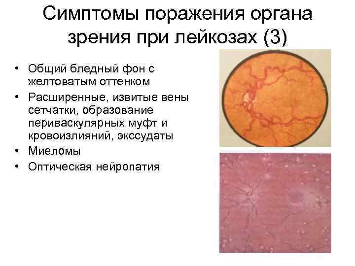 Симптомы поражения органа зрения при лейкозах (3) • Общий бледный фон с желтоватым оттенком