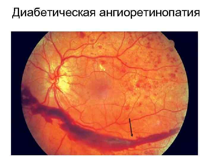 Диабетическая ангиоретинопатия – микроангиопатия. Стадии диабетической ангиоретинопатии: 1. Препролиферативная (непролиферативная) - микроаневризмы - интраретинальные