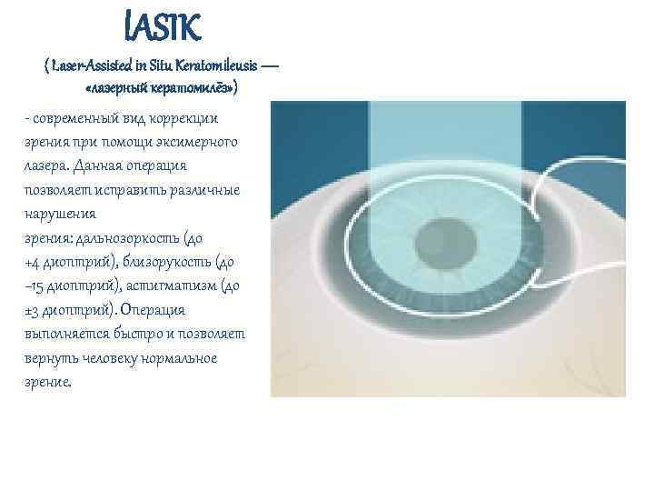 l. ASIK ( Laser-Assisted in Situ Keratomileusis — «лазерный кератомилёз» ) - современный вид