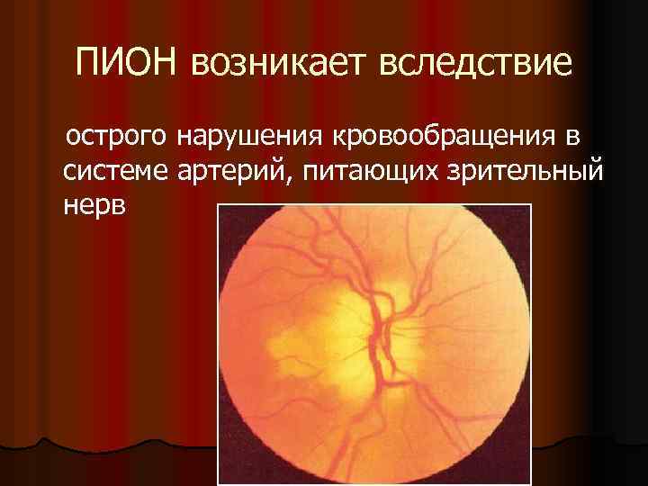 Нейропатия зрительных. Ишемическая нейропатия зрительного нерва симптомы. Передняя ишемическая невропатия зрительного нерва. Нейрооптикопатия зрительного нерва. Передняя ишемическая нейропатия глазное дно.