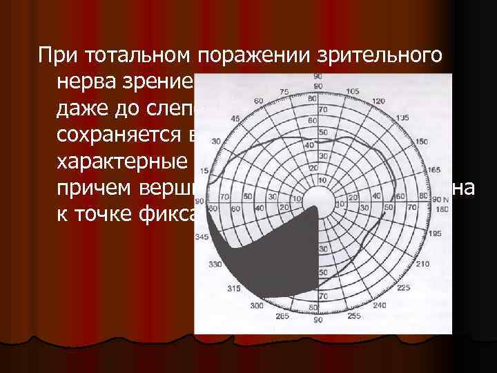 При тотальном поражении зрительного нерва зрение снижается до сотых и даже до слепоты, при