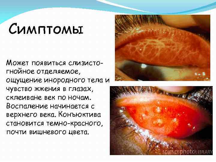 Симптомы Может появиться слизистогнойное отделяемое, ощущение инородного тела и чувство жжения в глазах, склеиване