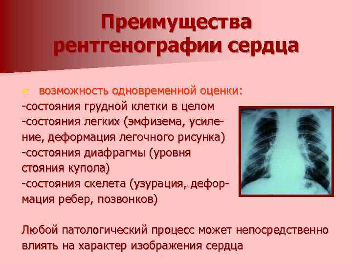 Преимущества рентгенографии сердца возможность одновременной оценки: -состояния грудной клетки в целом -состояния легких (эмфизема,