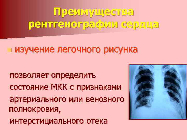 Преимущества рентгенографии сердца n изучение легочного рисунка позволяет определить состояние МКК с признаками артериального