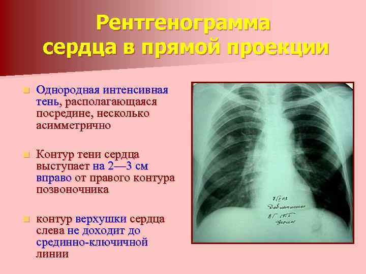 Рентгенограмма сердца в прямой проекции n Однородная интенсивная тень, располагающаяся посредине, несколько асимметрично n