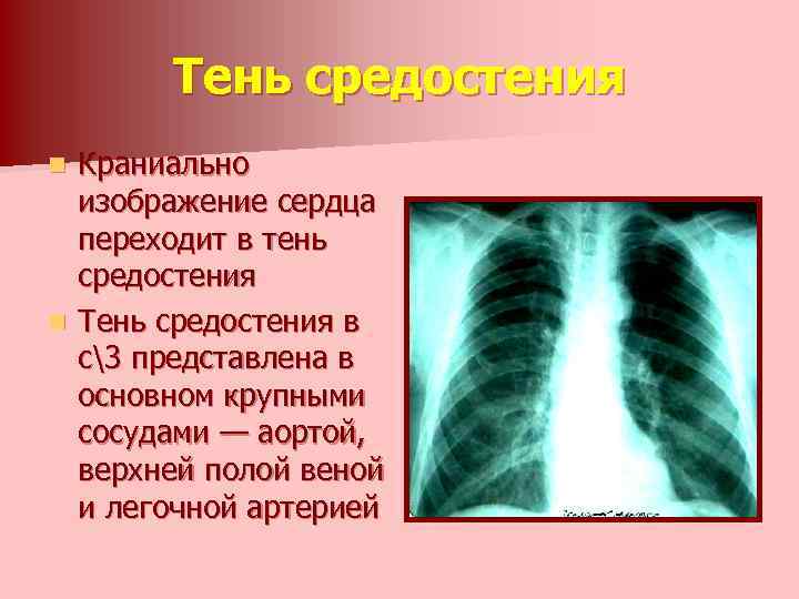 Тень средостения Краниально изображение сердца переходит в тень средостения n Тень средостения в с3