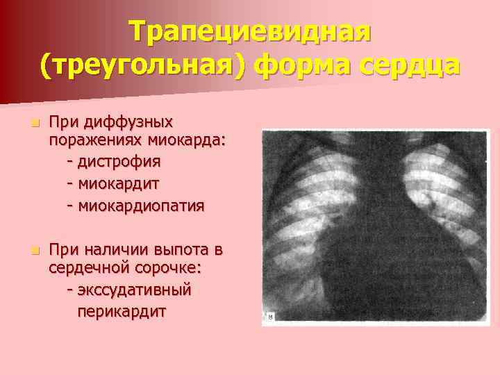 Трапециевидная (треугольная) форма сердца n При диффузных поражениях миокарда: - дистрофия - миокардит -