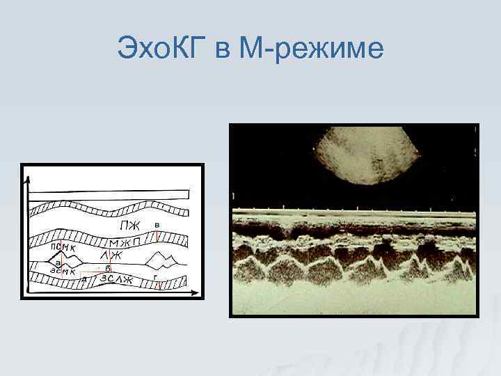 Эхо. КГ в М-режиме 