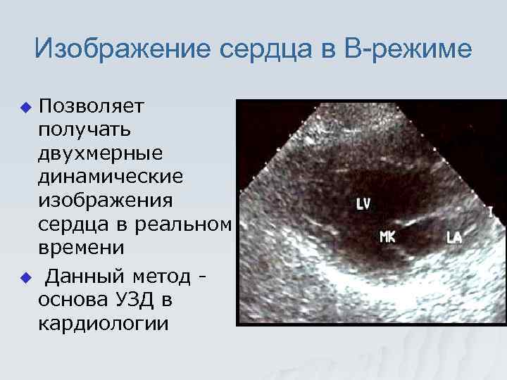 Изображение сердца в В-режиме Позволяет получать двухмерные динамические изображения сердца в реальном времени u