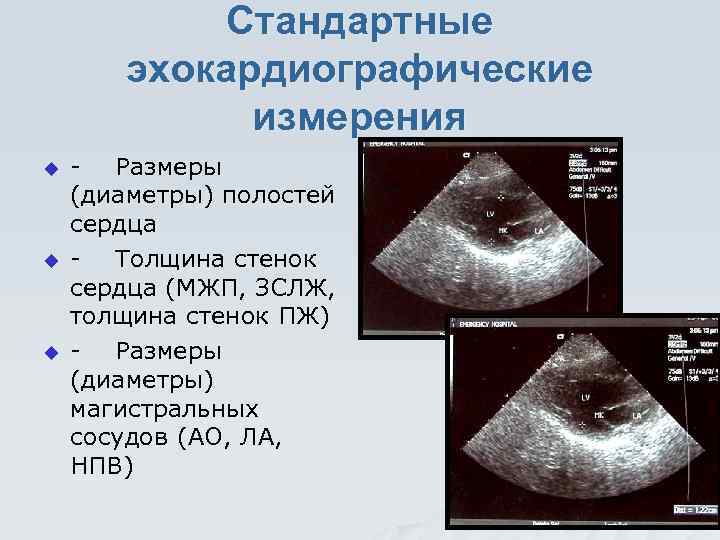 Стандартные эхокардиографические измерения u u u - Размеры (диаметры) полостей сердца - Толщина стенок