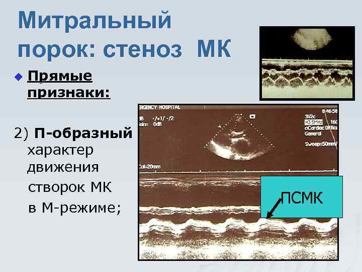 Митральный порок: стеноз МК u Прямые признаки: 2) П-образный характер движения створок МК в