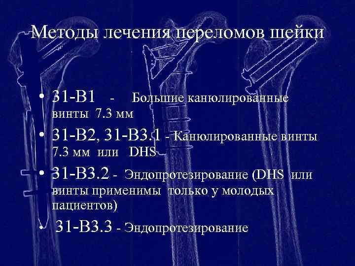 Методы лечения переломов шейки • 31 -В 1 - Большие канюлированные винты 7. 3