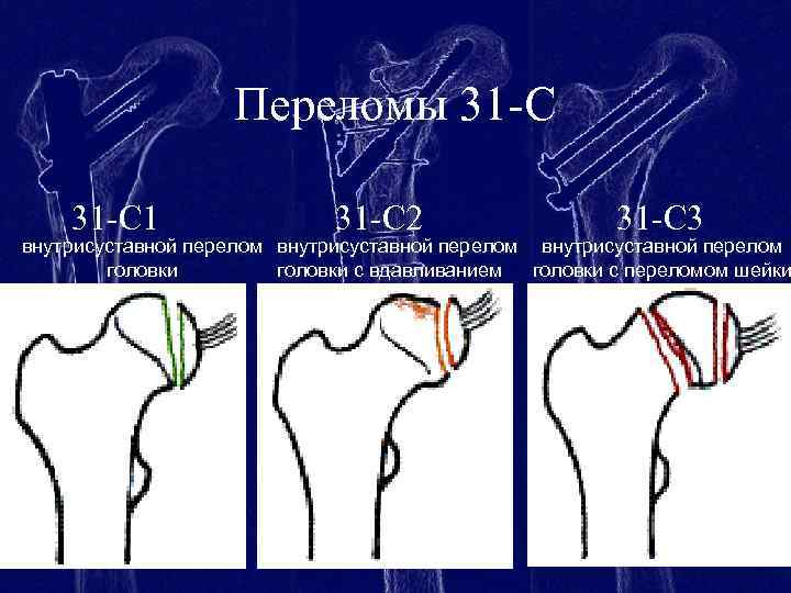 Закрытый перелом шейки бедра