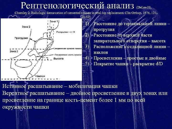 Рентгенологический анализ (De. Lee JS, Charnley J: Radiologic demarcation of cemented sockets in total