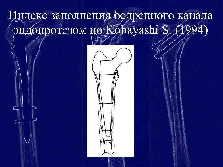 Проксимальный отдел бедренной кости где находится фото