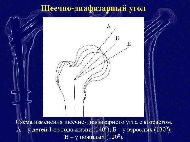 Шеечно-диафизарный угол Схема изменения шеечно-диафизарного угла с возрастом. А – у детей 1 -го