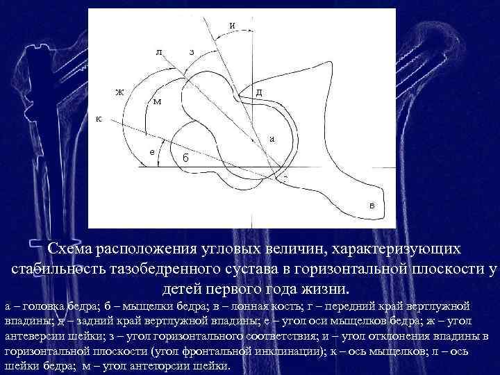 Рентгенологическая картина центрации головки бедра в пределах вертлужной впадины с обеих сторон