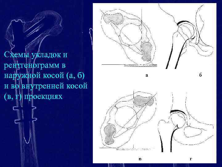 Схемы укладок и рентгенограмм в наружной косой (а, б) и во внутренней косой (в,