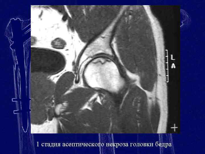 Асептический некроз головки бедренной