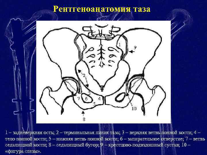 Рентгеноанатомия таза 1 – задневерхняя ость; 2 – терминальная линия таза; 3 – верхняя