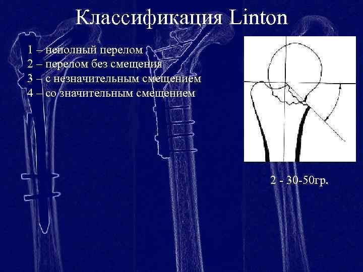 Классификация Linton 1 – неполный перелом 2 – перелом без смещения 3 – с