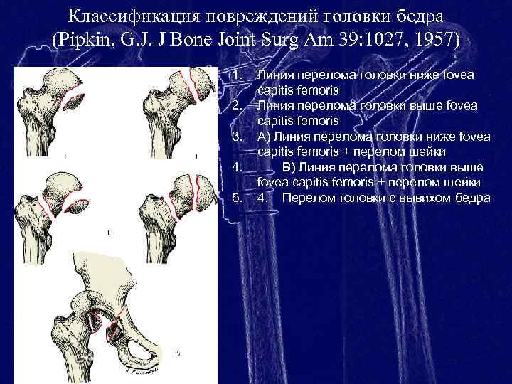 Проксимальный отдел бедренной кости