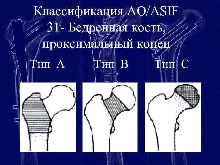 Проксимальный отдел кости. Переломы проксимального отдела бедра классификация ao. Повреждения проксимального отдела бедра. Классификация бедренной кости. Проксимальный метаэпифиз бедренной кости.