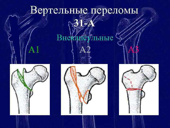 Вертельные переломы 31 -А Внекапсульные A 1 A 2 A 3 