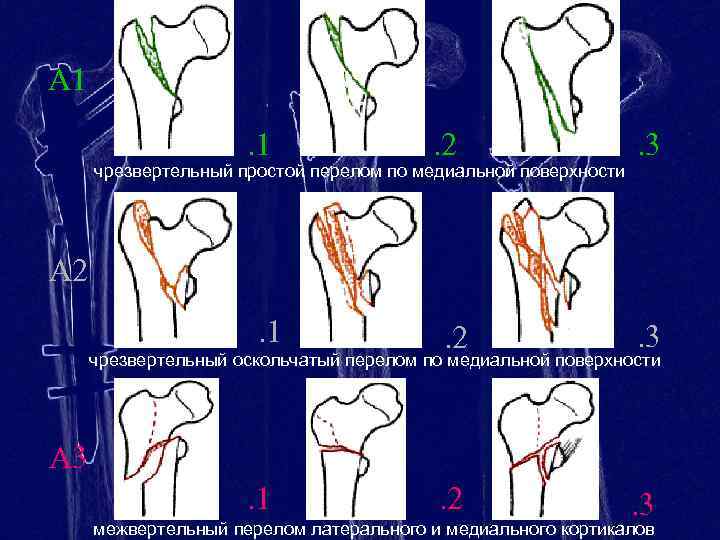 Перелом бедренной кости клинические рекомендации тесты нмо. Переломы проксимального отдела бедренной кости АО. Классификация переломов проксимального отдела бедра. Классификация переломов шейки бедренной кости. Вертельные переломы и переломы шейки бедра.