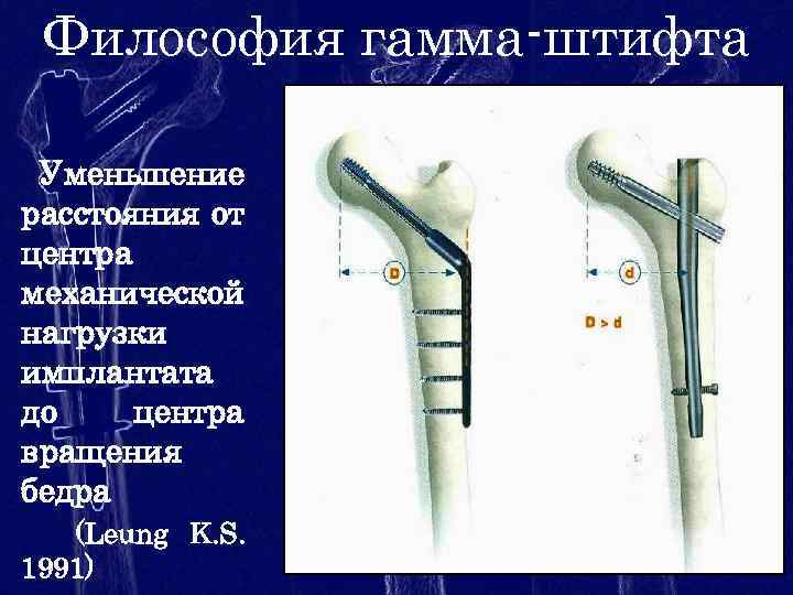 Философия гамма-штифта Уменьшение расстояния от центра механической нагрузки имплантата до центра вращения бедра (Leung