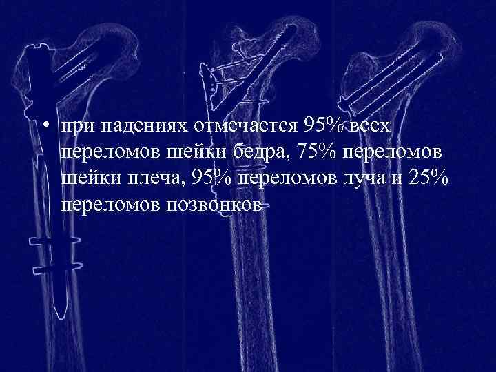  • при падениях отмечается 95% всех переломов шейки бедра, 75% переломов шейки плеча,