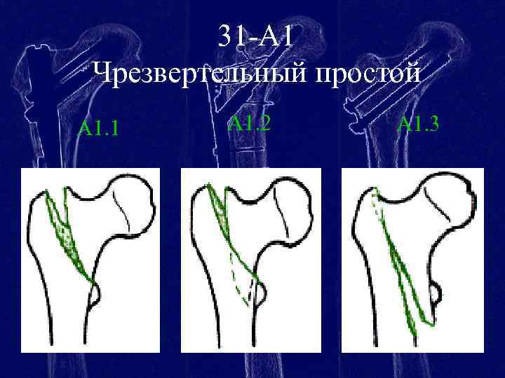 31 -А 1 Чрезвертельный простой А 1. 1 А 1. 2 А 1. 3