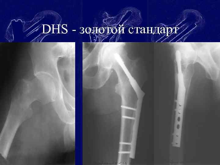 DHS - золотой стандарт 