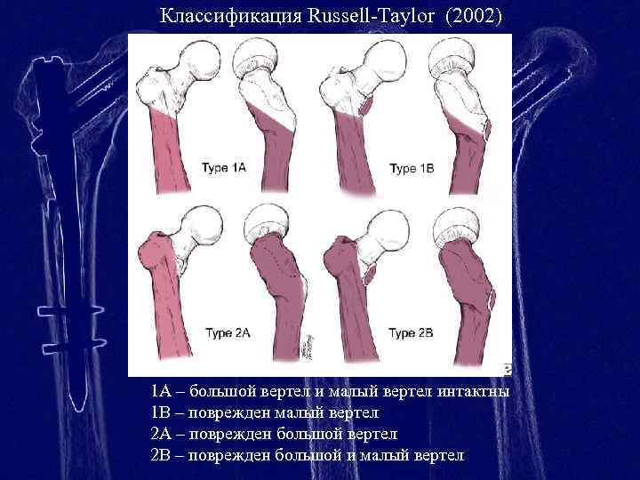 Перелом бедренной кости клинические рекомендации тесты нмо. Классификация переломов бедренной кости. Варусная деформация бедренной кости классификация. Деформация шейки бедренной кости.