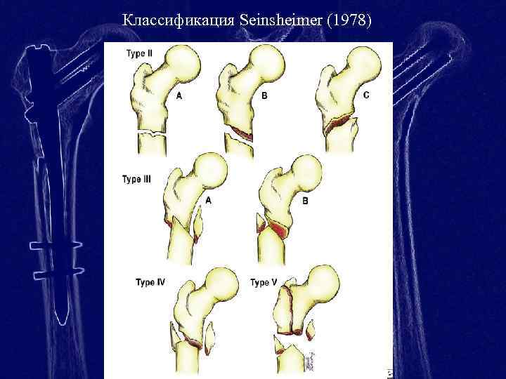 Классификация Seinsheimer (1978) 