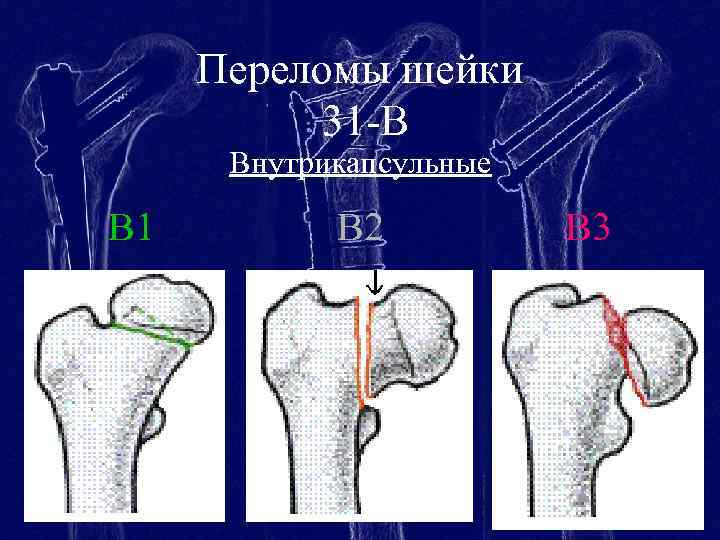 Переломы шейки 31 -B Внутрикапсульные B 1 B 2 B 3 