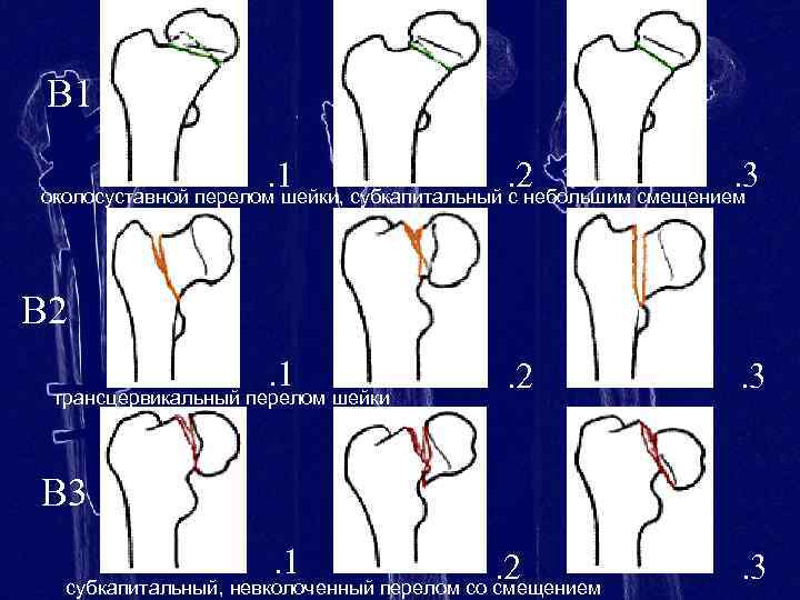 В 1. 1. 2. 3 околосуставной перелом шейки, субкапитальный с небольшим смещением В 2.