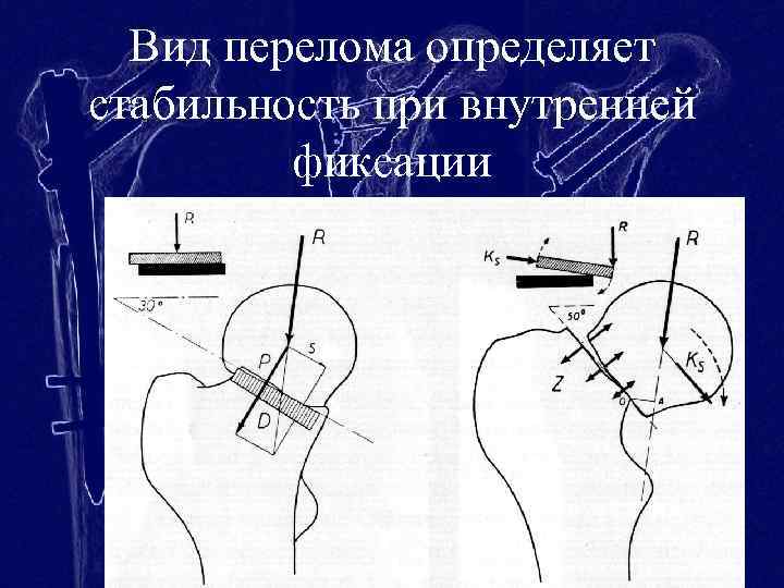 Вид перелома определяет стабильность при внутренней фиксации 