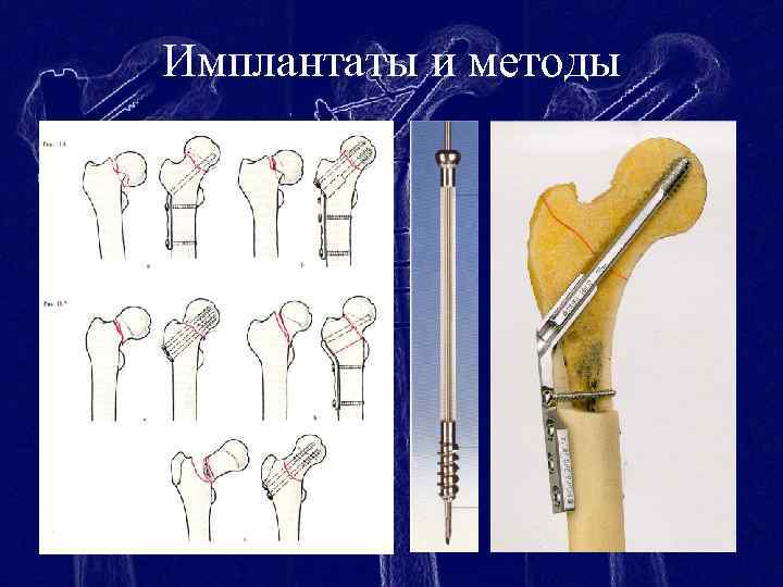 Имплантаты и методы 