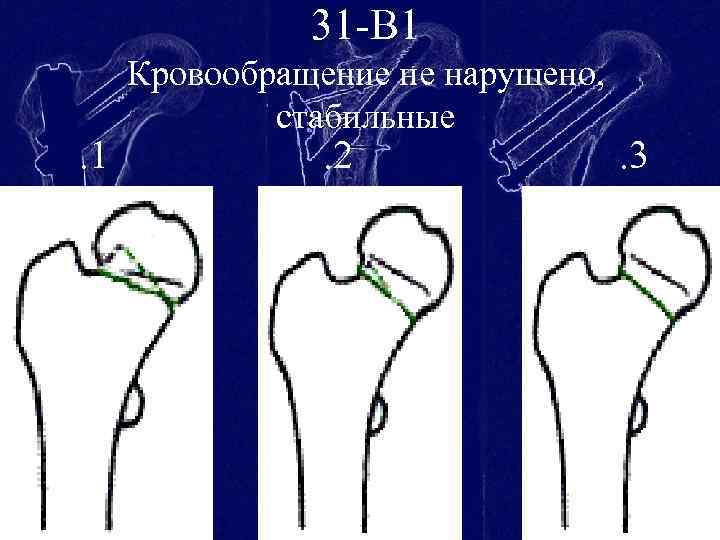 31 -В 1. 1 Кровообращение не нарушено, стабильные . 2 . 3 