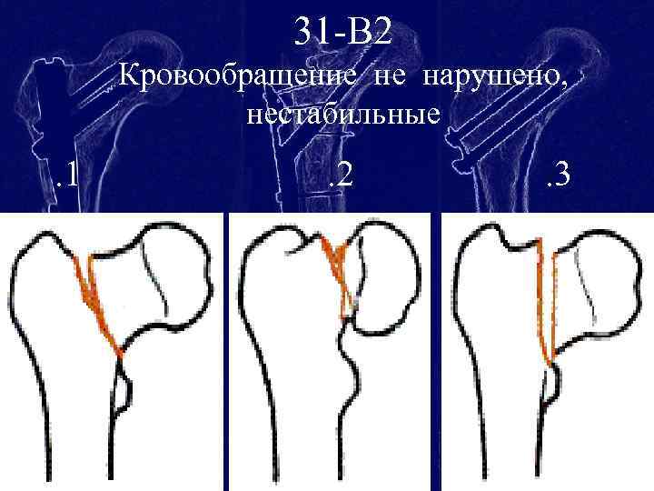 31 -В 2 Кровообращение не нарушено, нестабильные . 1 . 2 . 3 