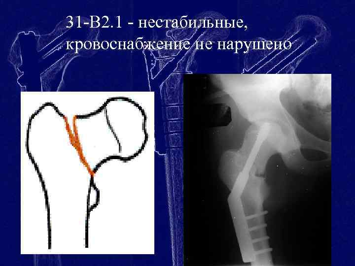 31 -В 2. 1 - нестабильные, кровоснабжение не нарушено 