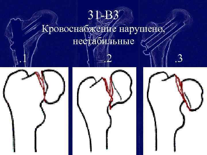 Пиявки при коксартрозе тазобедренного сустава схема - 97 фото