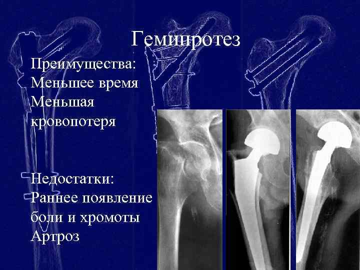 Гемипротез Преимущества: Меньшее время Меньшая кровопотеря Недостатки: Раннее появление боли и хромоты Артроз 