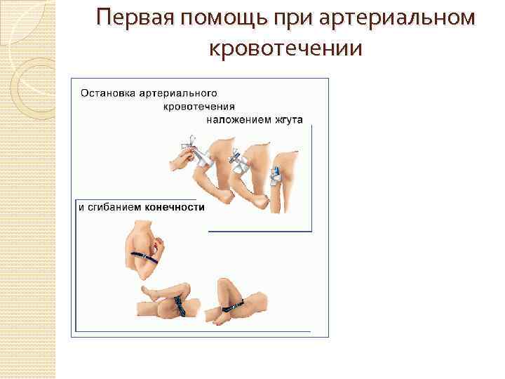 Первая помощь при артериальном кровотечении 